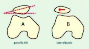 Onderzoek patella artrose